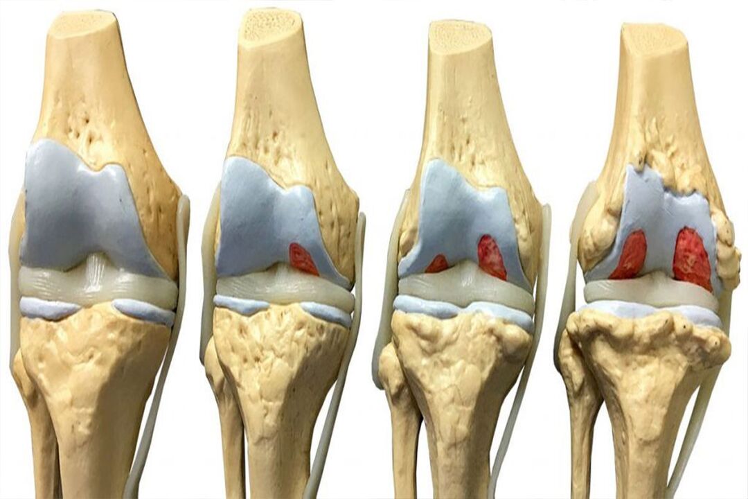 ដំណាក់កាលនៃការអភិវឌ្ឍន៍ arthrosis