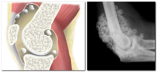 chondromatosis ជាមួយនឹងការឈឺចាប់នៅក្នុងសន្លាក់ត្រគាក