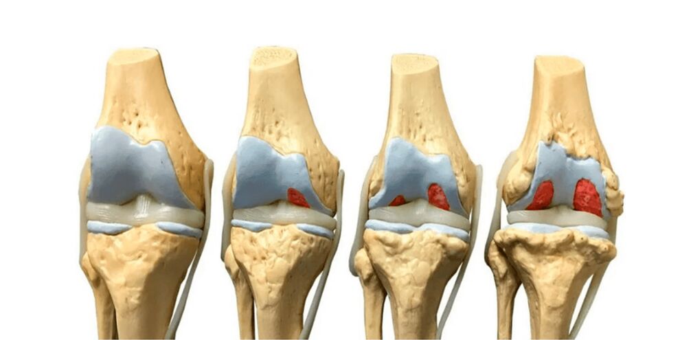 កម្រិតនៃ arthrosis នៃសន្លាក់